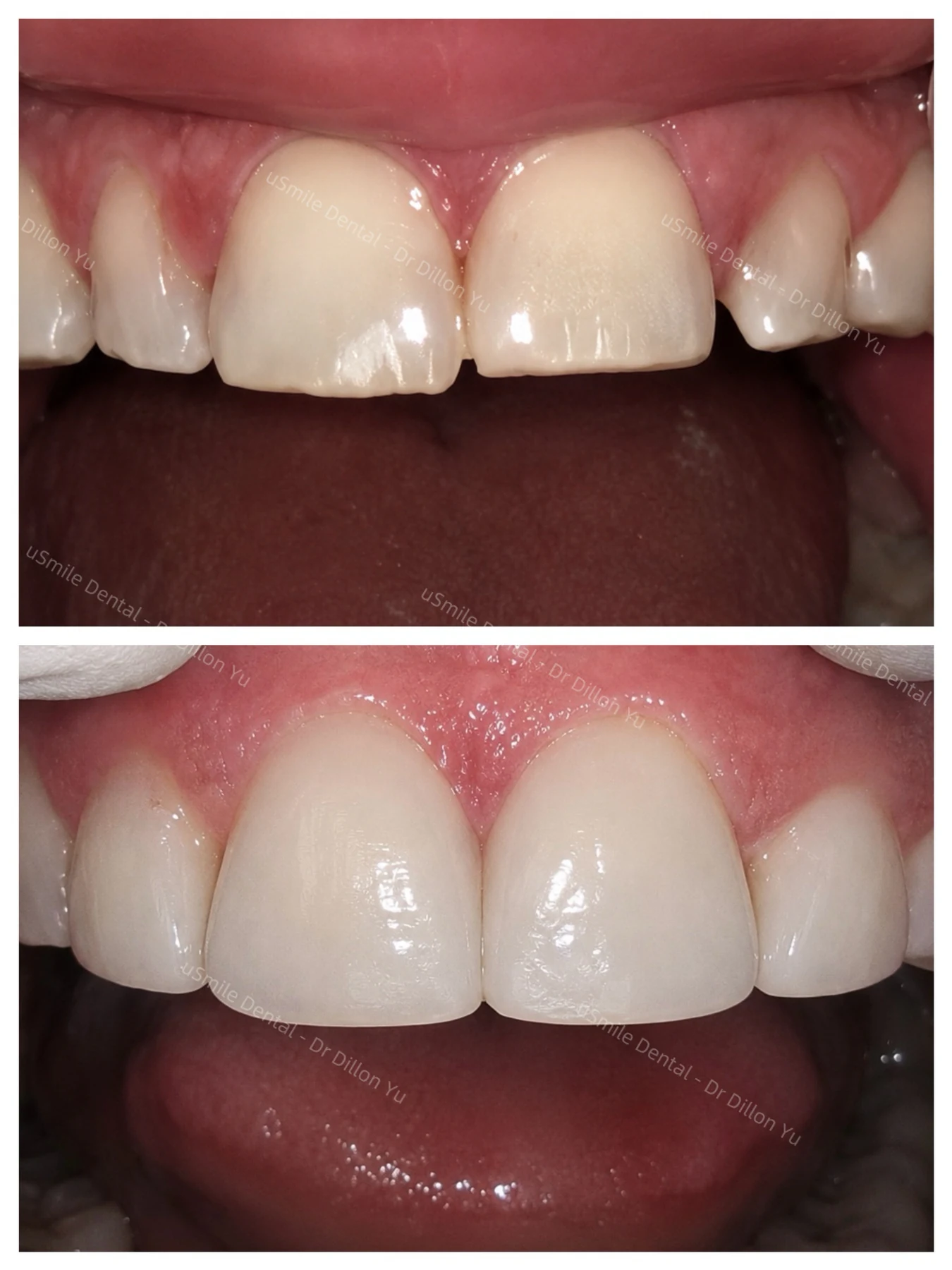 Crowns & veneers · case 01 — supplied clinical comparison