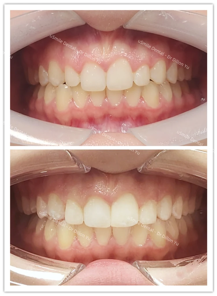 Crowns & veneers · case 02 — supplied clinical comparison