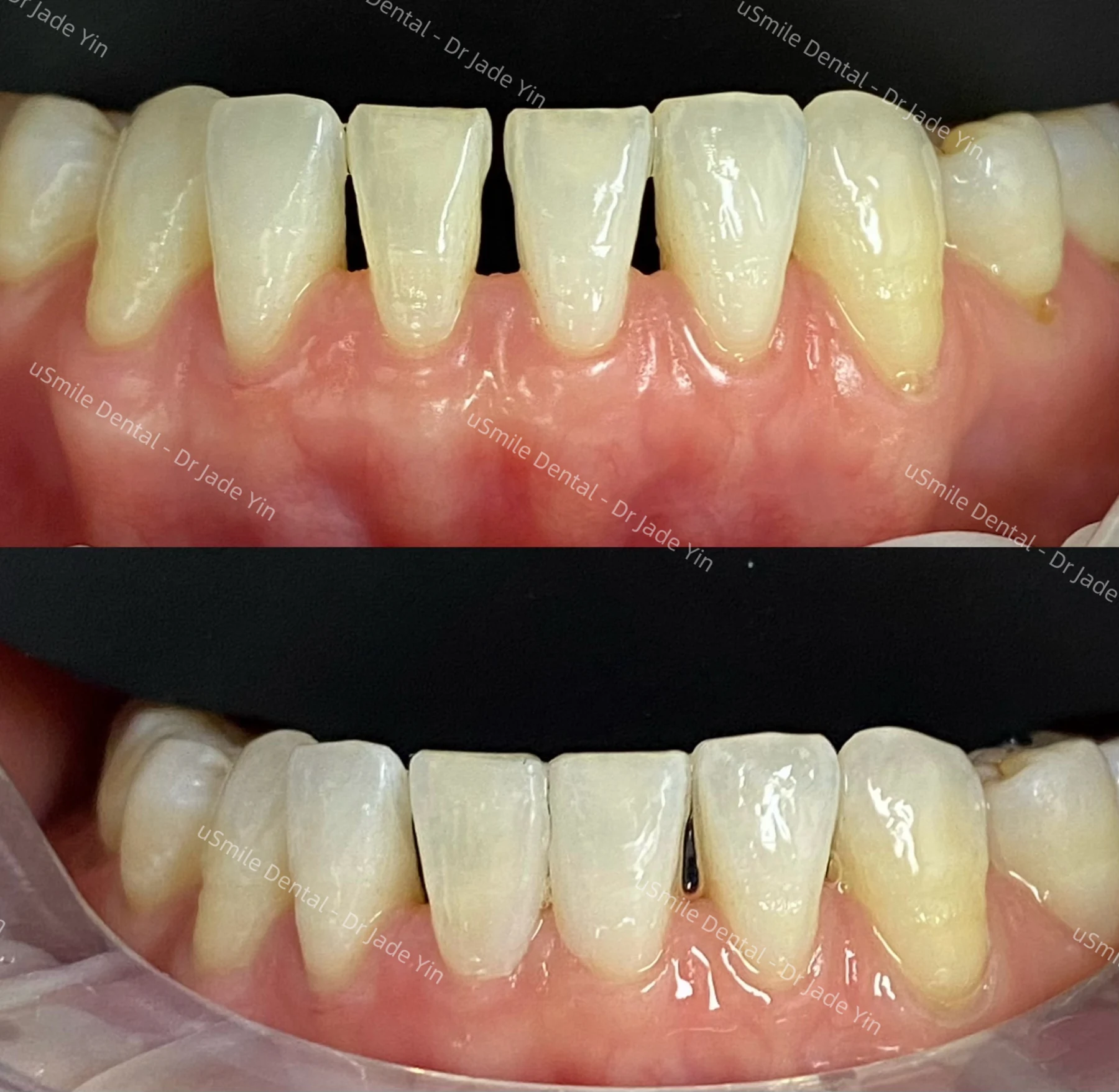 Crowns & veneers · case 03 — supplied clinical comparison