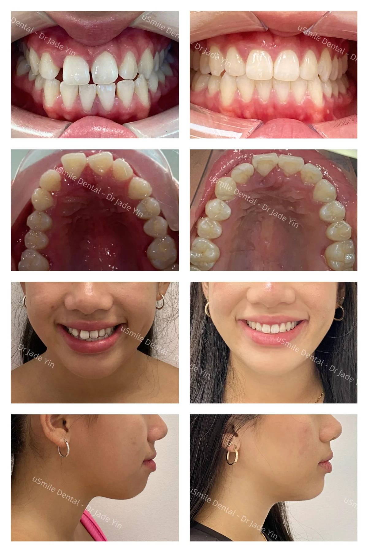 Invisalign · case 04 — supplied clinical comparison