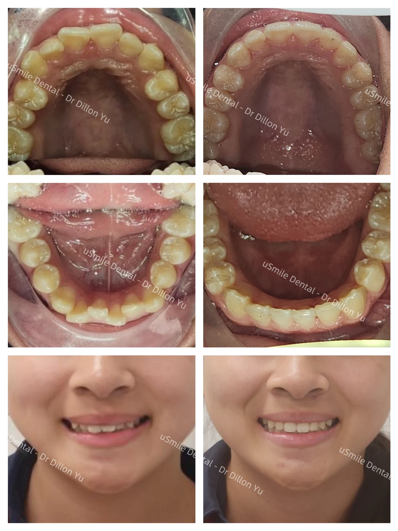Invisalign · case 05 — supplied clinical comparison