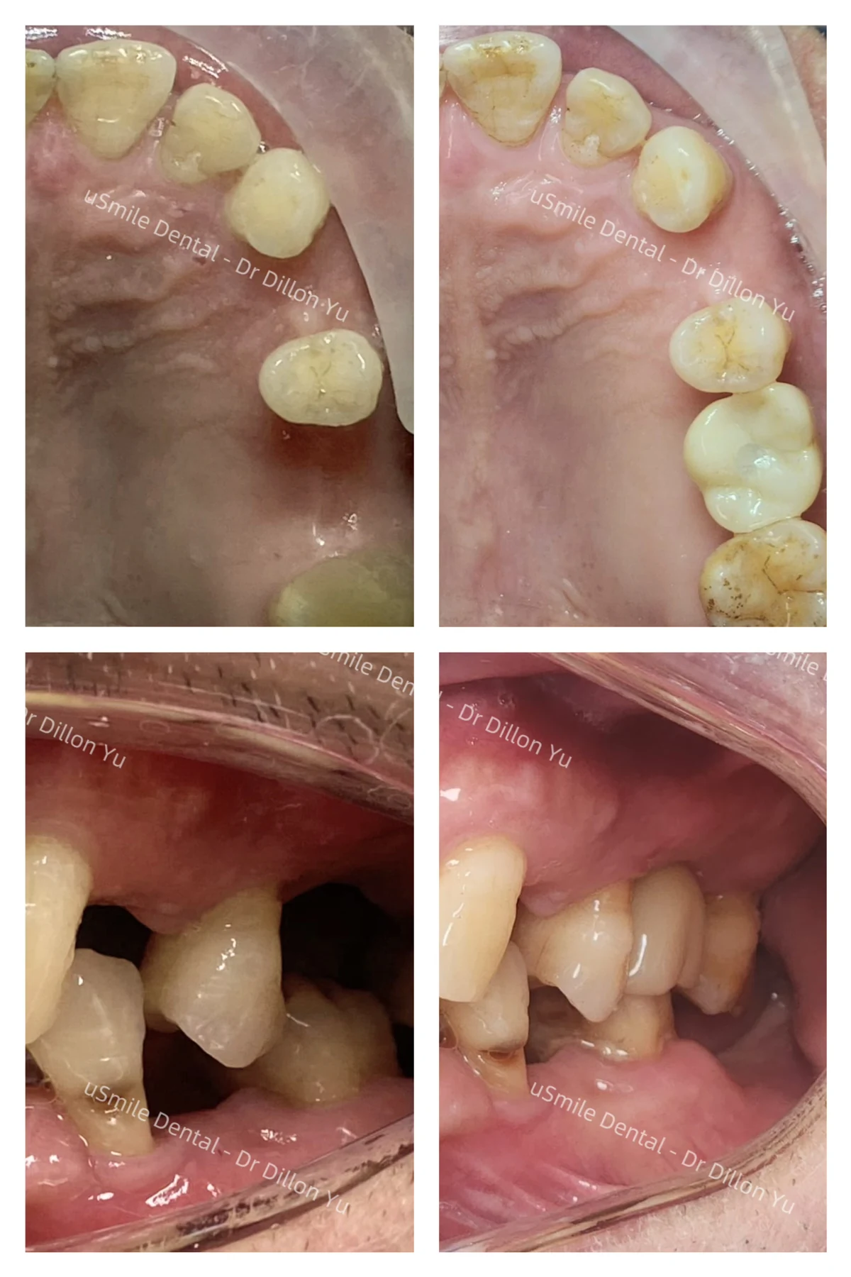 Implants · case 06 — supplied clinical comparison