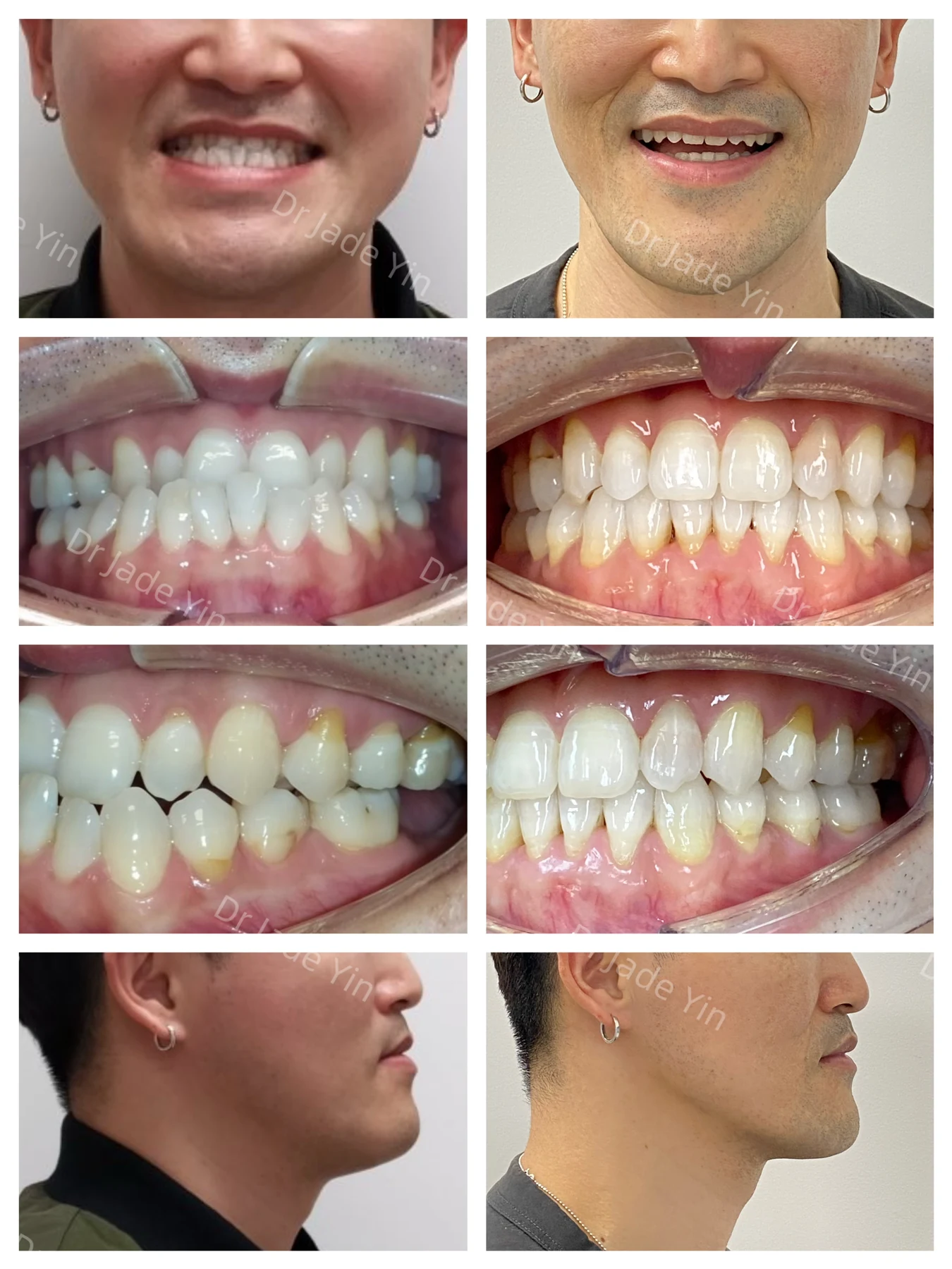 Invisalign · case 08 — supplied clinical comparison