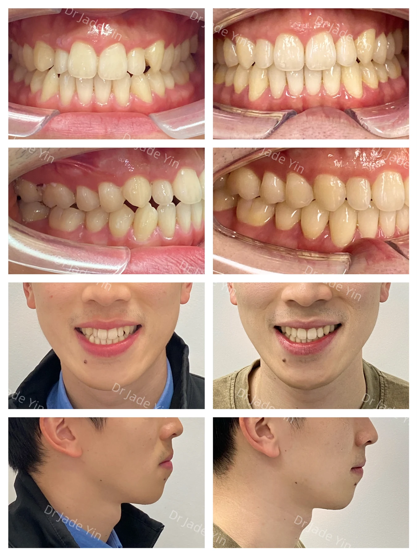 Invisalign · case 10 — supplied clinical comparison