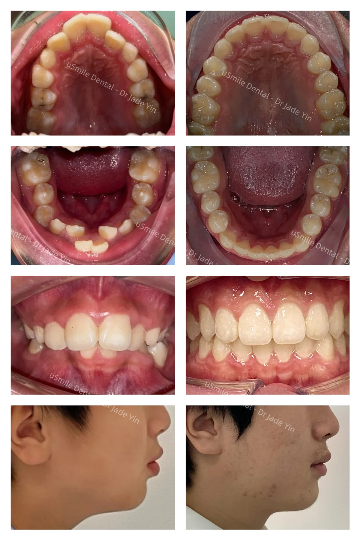 Invisalign · case 11 — supplied clinical comparison