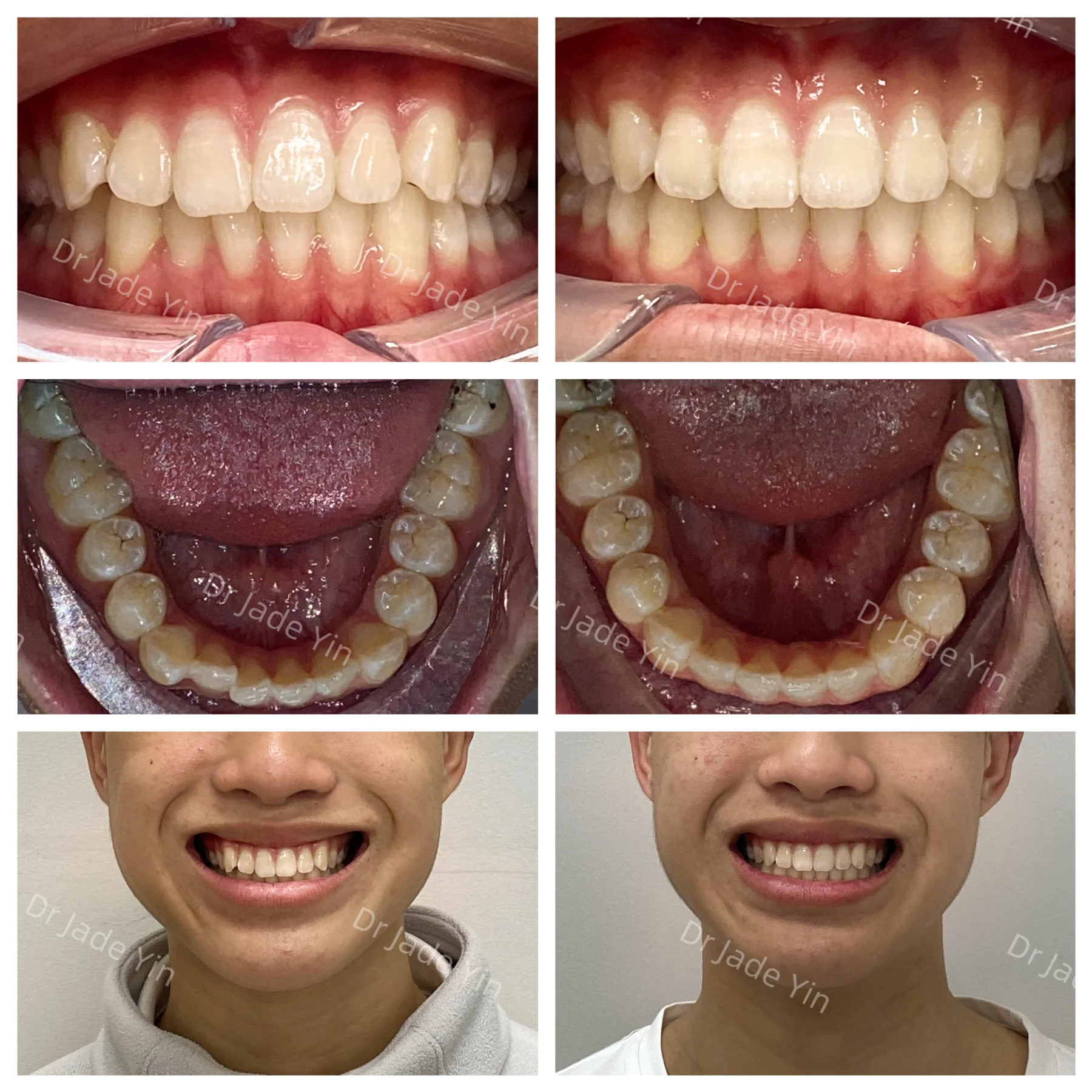 Invisalign · case 12 — supplied clinical comparison