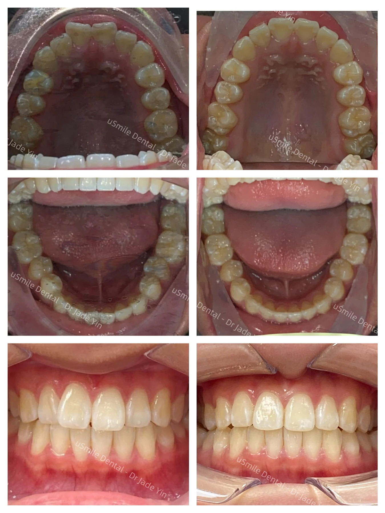 Invisalign · case 13 — supplied clinical comparison