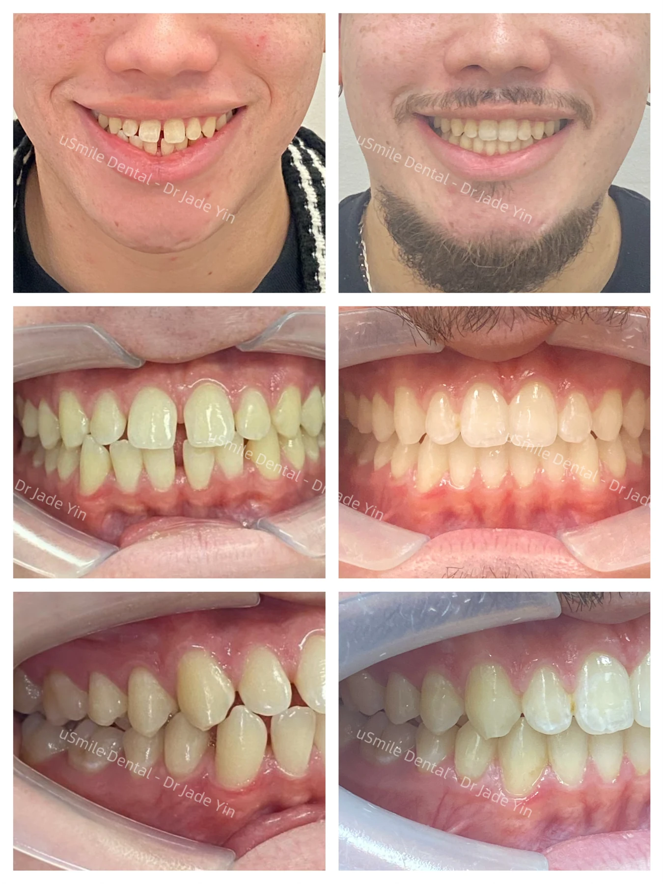 Invisalign · case 14 — supplied clinical comparison
