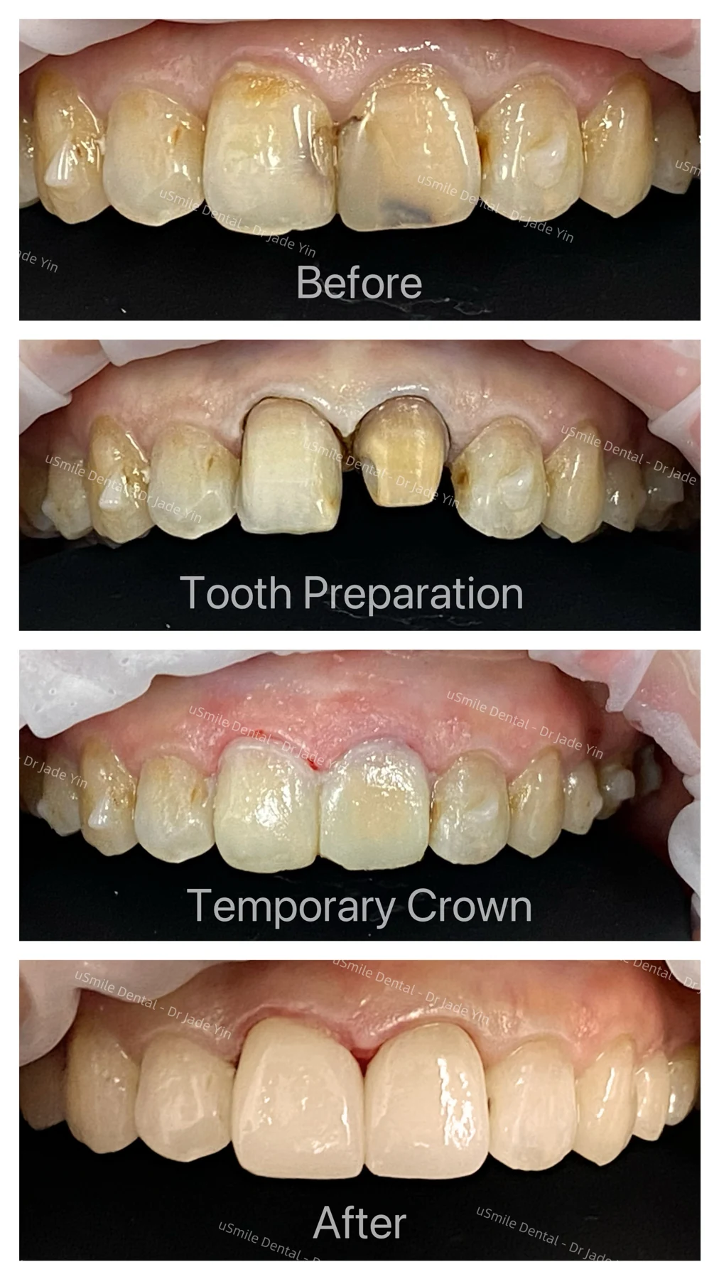 Crowns & veneers · case 15 — supplied clinical comparison
