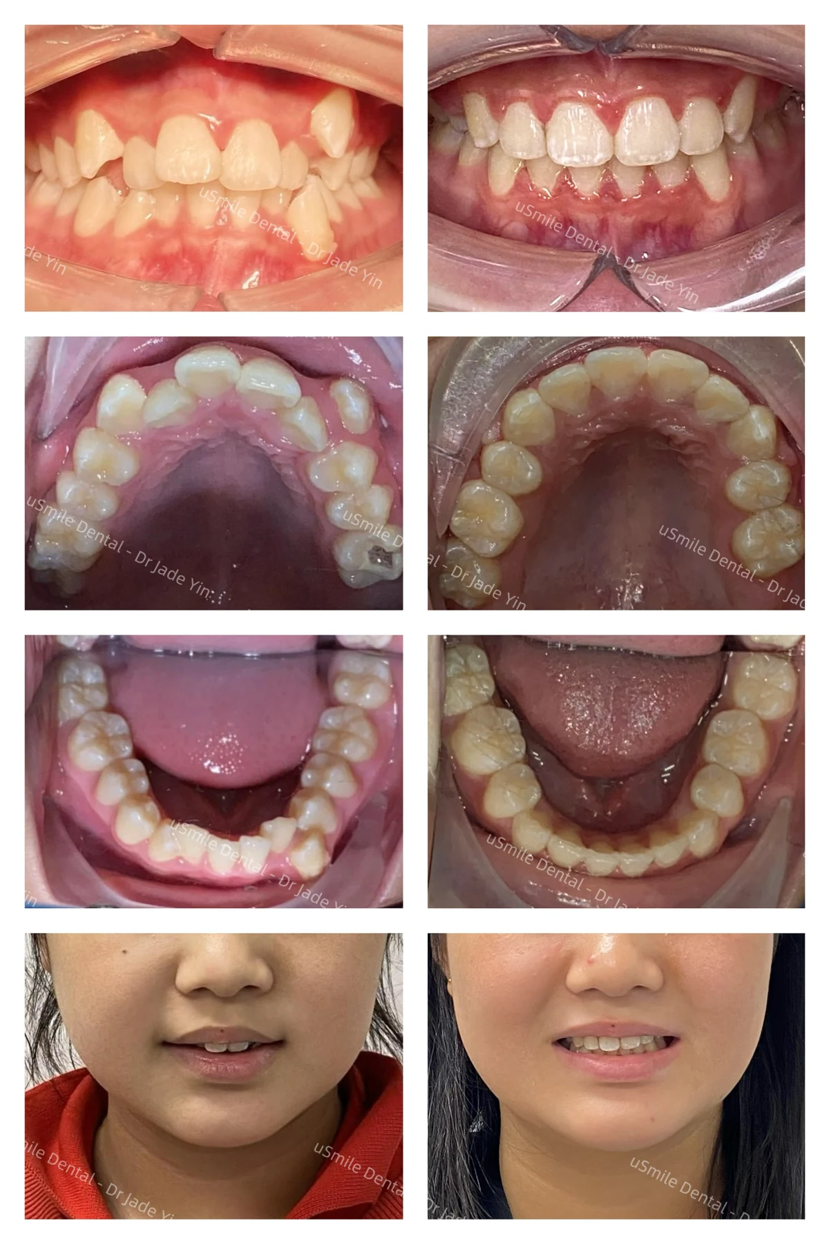 Braces · case 16 — supplied clinical comparison
