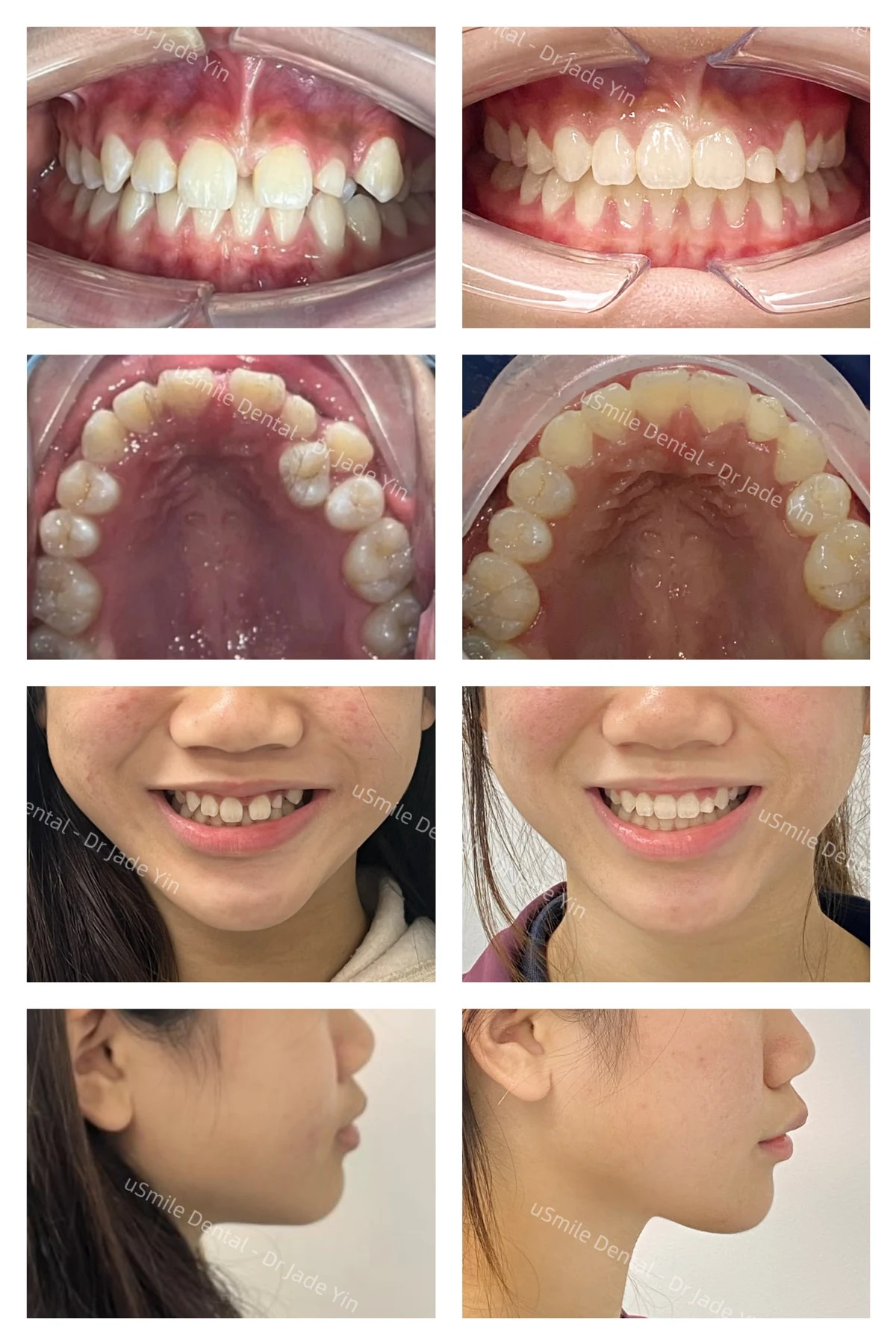 Braces · case 17 — supplied clinical comparison