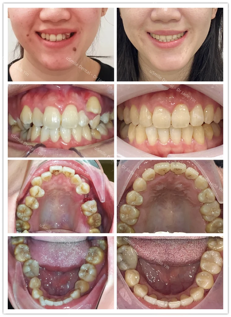 Invisalign · case 18 — supplied clinical comparison