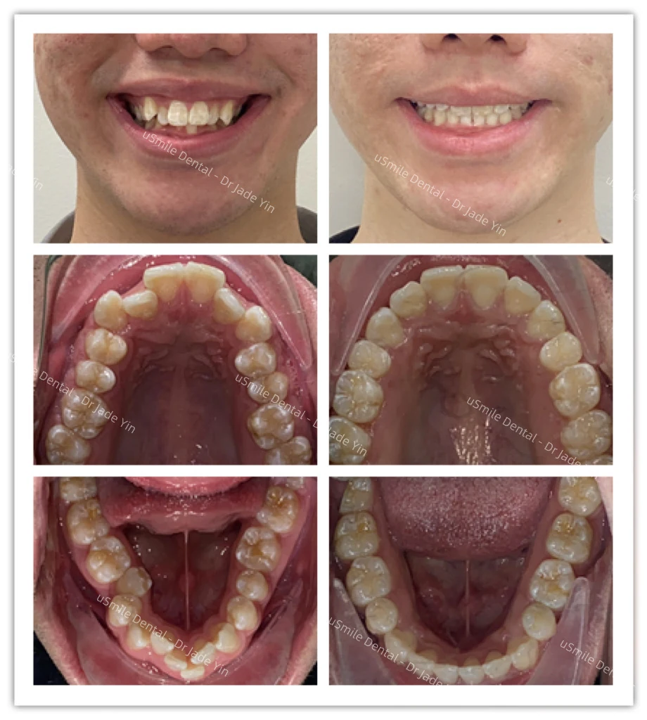 Invisalign · case 19 — supplied clinical comparison