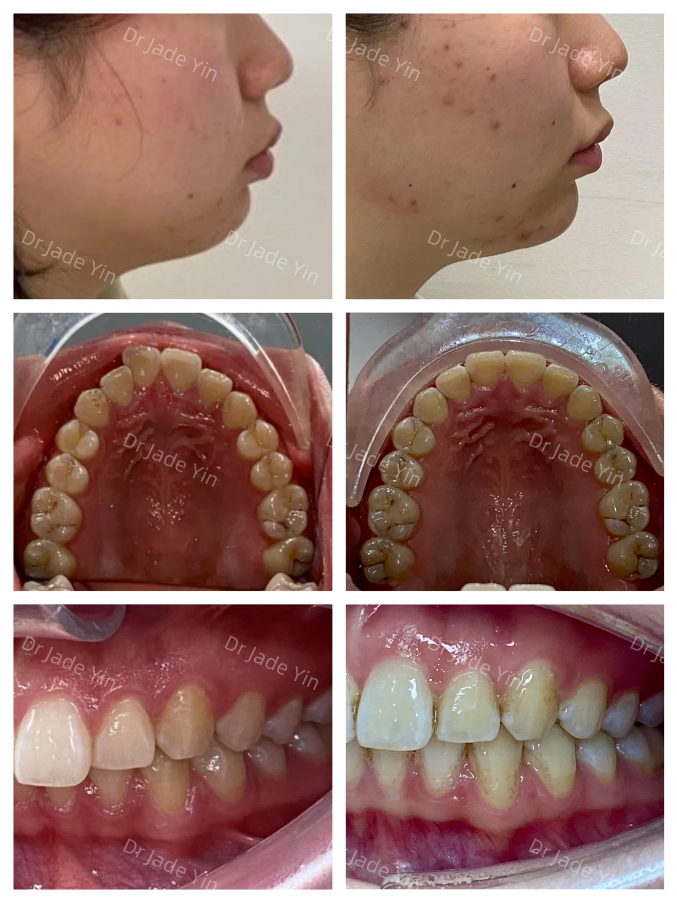 Invisalign · case 20 — supplied clinical comparison