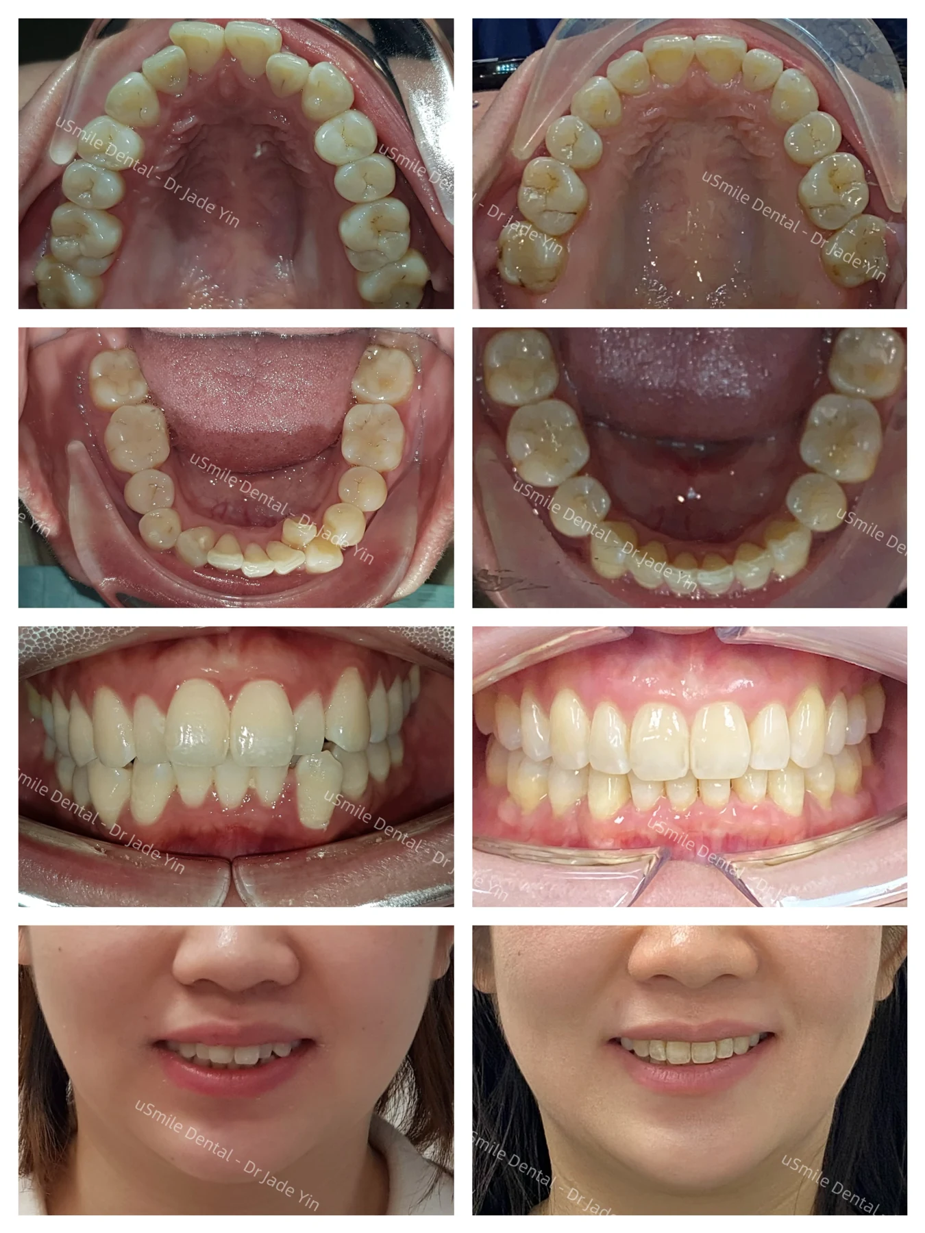Invisalign · case 21 — supplied clinical comparison