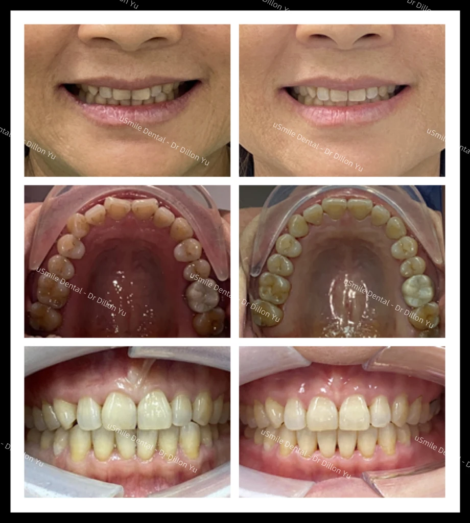 Invisalign · case 22 — supplied clinical comparison