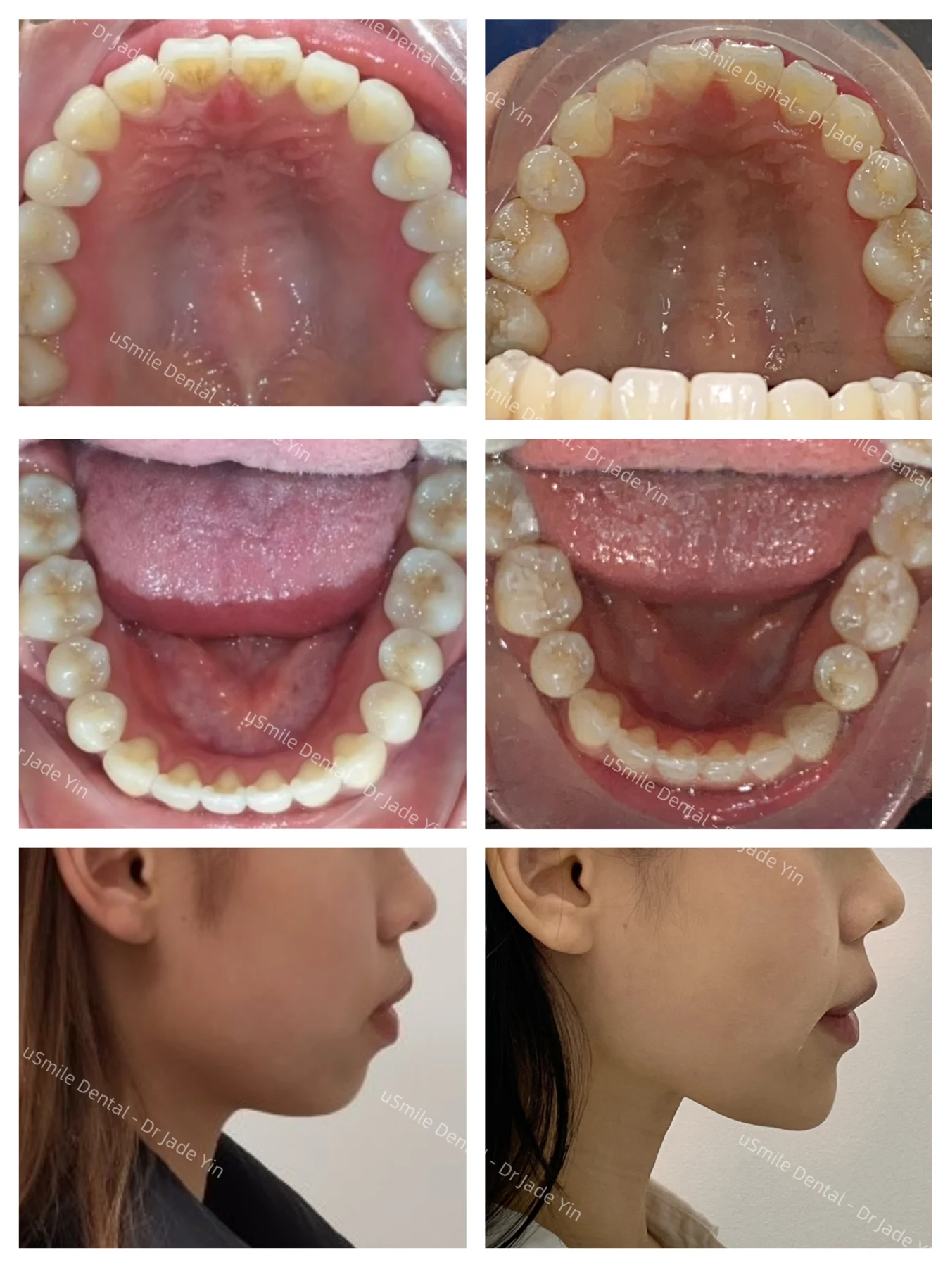 Invisalign · case 23 — supplied clinical comparison