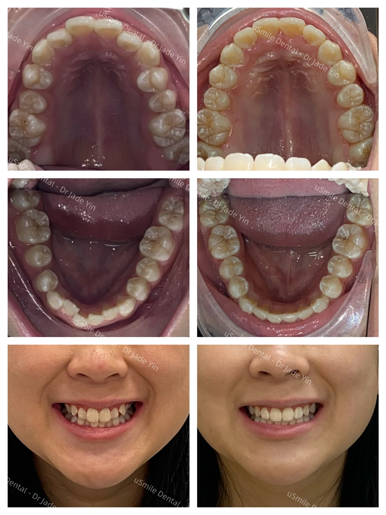 Invisalign · case 24 — supplied clinical comparison