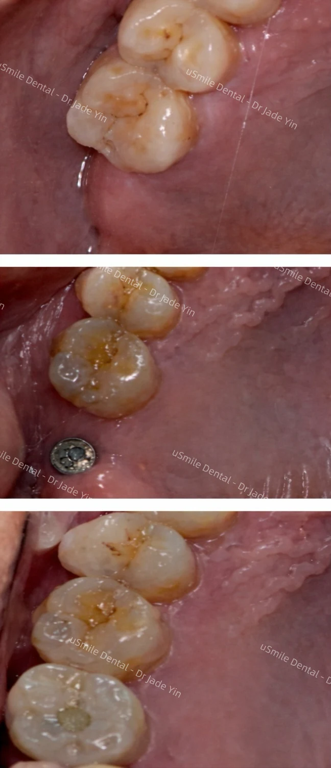 Implants · case 26 — supplied clinical comparison