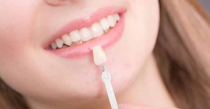 Dental Veneers - uSmile Dental | $60 Consultation