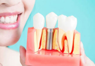 Everything You Need To Know Before Getting Dental Implants